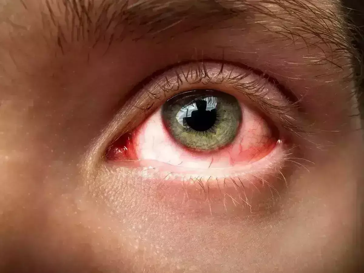 तेज़ी से फ़ैल रहा EYE FLU बच्चो का रखे ख्याल ! तेज़ी से फ़ैल रहा EYE FLU बच्चो का रखे ख्याल !
