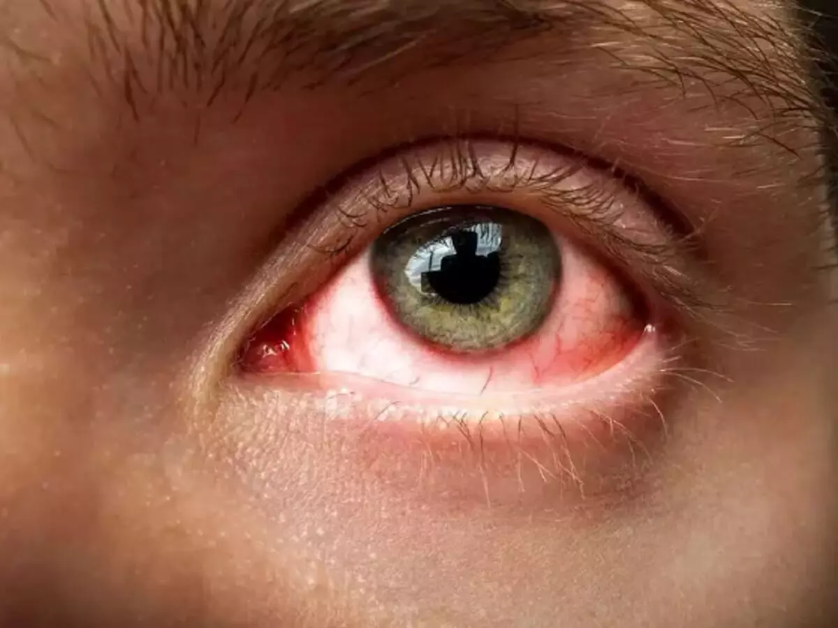 Eye flu: तेजी से फैल रहा आई फ्लू, स्वास्थ्य केंद्र पर रोज पहुंच रहे 30 से 40 मरीज, रहें सावधान Eye flu: तेजी से फैल रहा आई फ्लू, स्वास्थ्य केंद्र पर रोज पहुंच रहे 30 से 40 मरीज, रहें सावधान