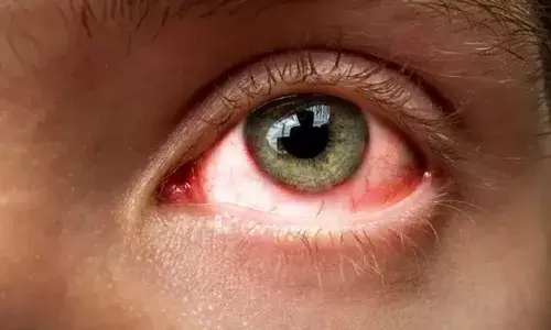 Eye flu: तेजी से फैल रहा आई फ्लू, स्वास्थ्य केंद्र पर रोज पहुंच रहे 30 से 40 मरीज, रहें सावधान