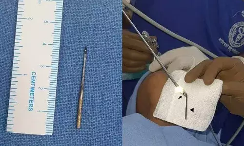 चार सेंटीमीटर सुई निगल गया बच्चा: एम्स के डॉक्टरों ने ऑपरेशन कर निकाली, छाती के लेफ्ट साइड फंसी थी सुई चार सेंटीमीटर सुई निगल गया बच्चा: एम्स के डॉक्टरों ने ऑपरेशन कर निकाली, छाती के लेफ्ट साइड फंसी थी सुई