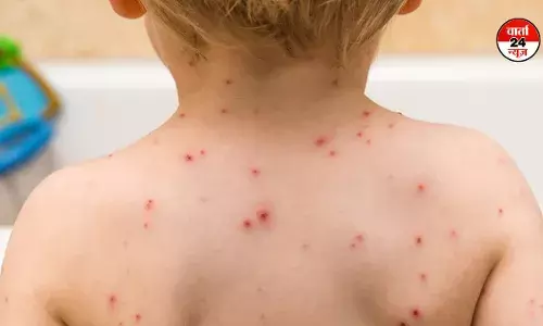 खतरनाक एमपॉक्स अब भारत में दे सकती है दस्तक! अस्पतालों में आइसोलेशन वार्ड हो रहे हैं तैयार