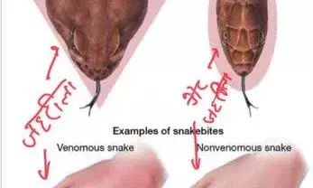 सांप काट ले तो तुरंत में कैसे करें उपचार, इन गलतियों से बचें सांप काट ले तो तुरंत में कैसे करें उपचार, इन गलतियों से बचें