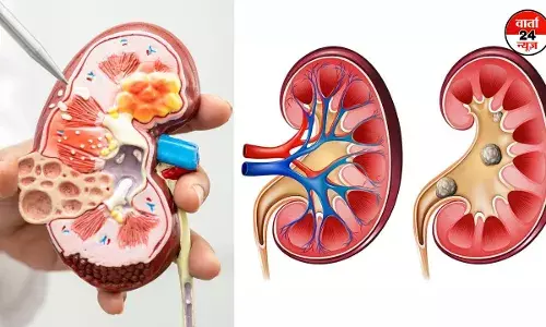 Kidney Stone: कैसे होती है गुर्दे की पथरी, जानें इसके लक्षण, कारण और घरेलू उपायों के बारें में Kidney Stone: कैसे होती है गुर्दे की पथरी, जानें इसके लक्षण, कारण और घरेलू उपायों के बारें में