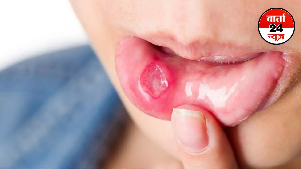 Mouth Ulcers: मुंह के छालों से है परेशान, जानें कुछ घरेलू उपाय, लक्षण और कारण Mouth Ulcers: मुंह के छालों से है परेशान, जानें कुछ घरेलू उपाय, लक्षण और कारण