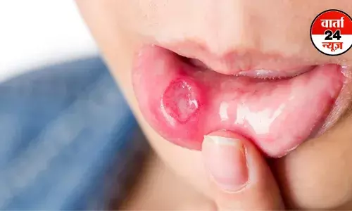 Mouth Ulcers: मुंह के छालों से है परेशान, जानें कुछ घरेलू उपाय, लक्षण और कारण Mouth Ulcers: मुंह के छालों से है परेशान, जानें कुछ घरेलू उपाय, लक्षण और कारण