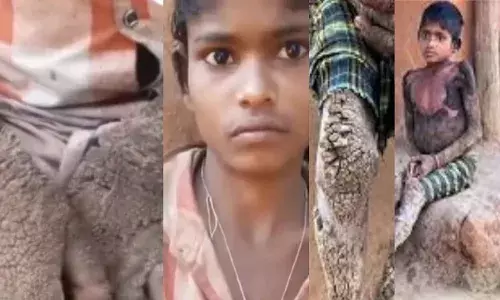 चौंकिए मत यह सच है... 14 साल की लड़की का शरीर पत्थर में हो रहा है तब्दील!जानें इस बारे में डॉक्टर का कहना