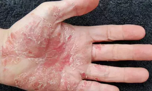 सोराइसिस की बीमारी होने के क्या हैं कारण, जानें इसके निवारण के उपाय