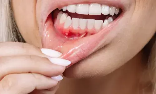 क्या आपके भी मुंह में बार-बार हो रहे हैं छाले तो ना करें नजरअंदाज, वरना हो सकती है यह लाइलाज बीमारी