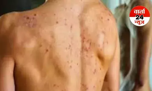 सेप्टीसीमिया (Septicemia) रोग क्या है, जानें इसके लक्षण और निवारण के उपाय...